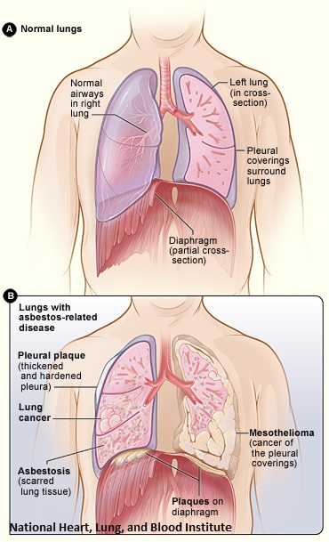 asbestos lungs