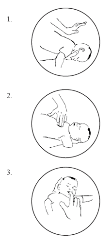 Illustration showing how to perform the Infant Heimlich Maneuver